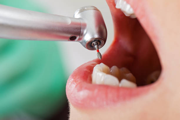 Best Emergency Root Canal Treatment in Des C, AR